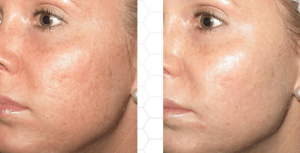 Microneedling Hagerstown