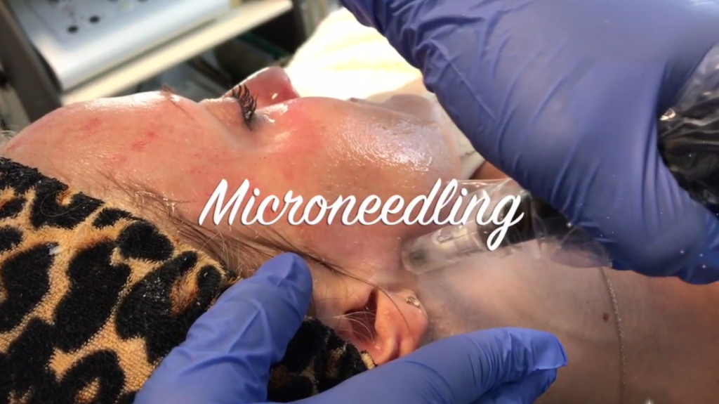 Microneedling Hagerstown