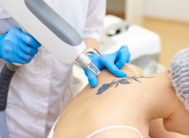 Tattoo Removal  Washington DC  Center for Laser Surgery