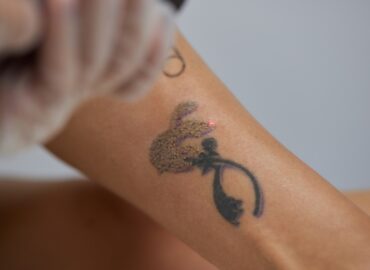 Budgeting for Tattoo Removal Cost in Mercersburg, Pennsylvania