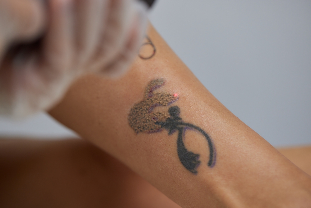 Budgeting for Tattoo Removal Cost in Mercersburg, Pennsylvania