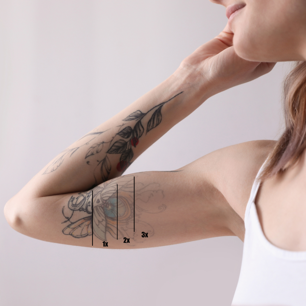 Permanent Tattoo Removal in Waynesboro PA