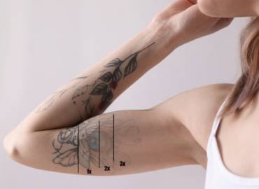 Guide to Permanent Tattoo Removal in Waynesboro, PA: Treatment, Results, and More!