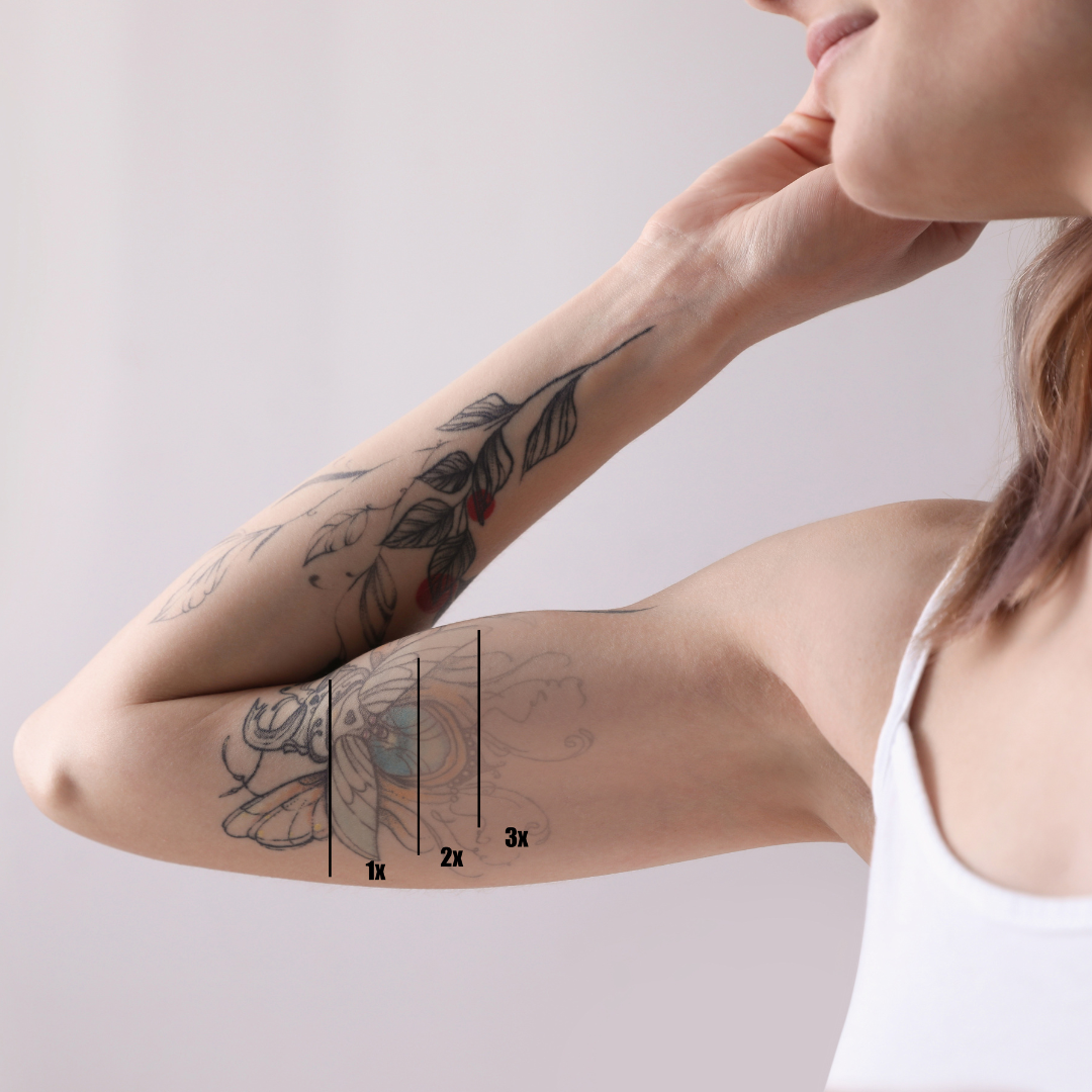 Guide to Permanent Tattoo Removal in Waynesboro, PA: Treatment, Results, and More!