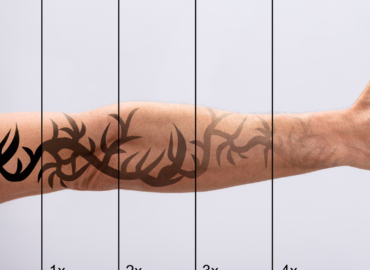 Tattoo Removal Before and Afters in Frederick: Your Guide to Remarkable Results