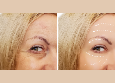 Botox Before and Afters in Frederick: Tips for Fantastic Results