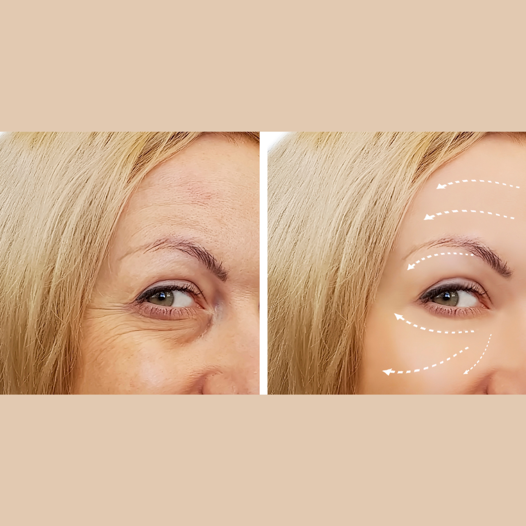 Botox Before and Afters in Frederick: Tips for Fantastic Results