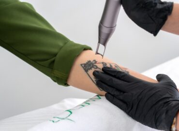 Say Goodbye to Ink Regrets With Laser Tattoo Removal Near West VA
