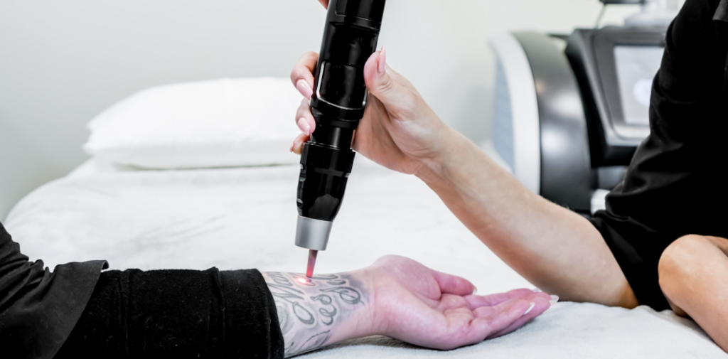 Laser Tattoo Removal Near Boonsboro