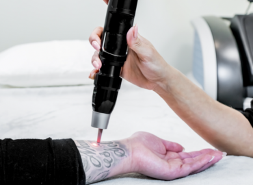 Laser Tattoo Removal Near Boonsboro, Maryland