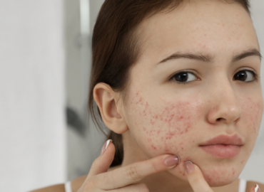 Best Acne Specialist Near Waynesboro