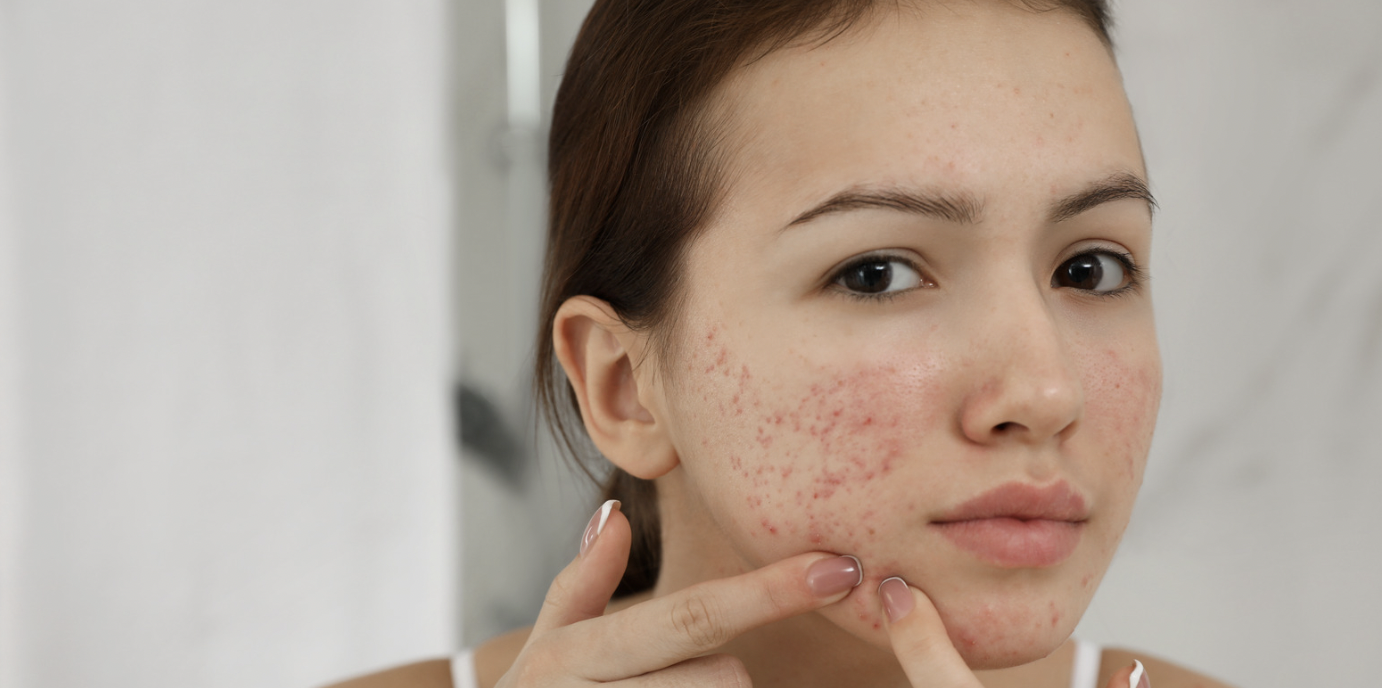 Best Acne Specialist Near Waynesboro