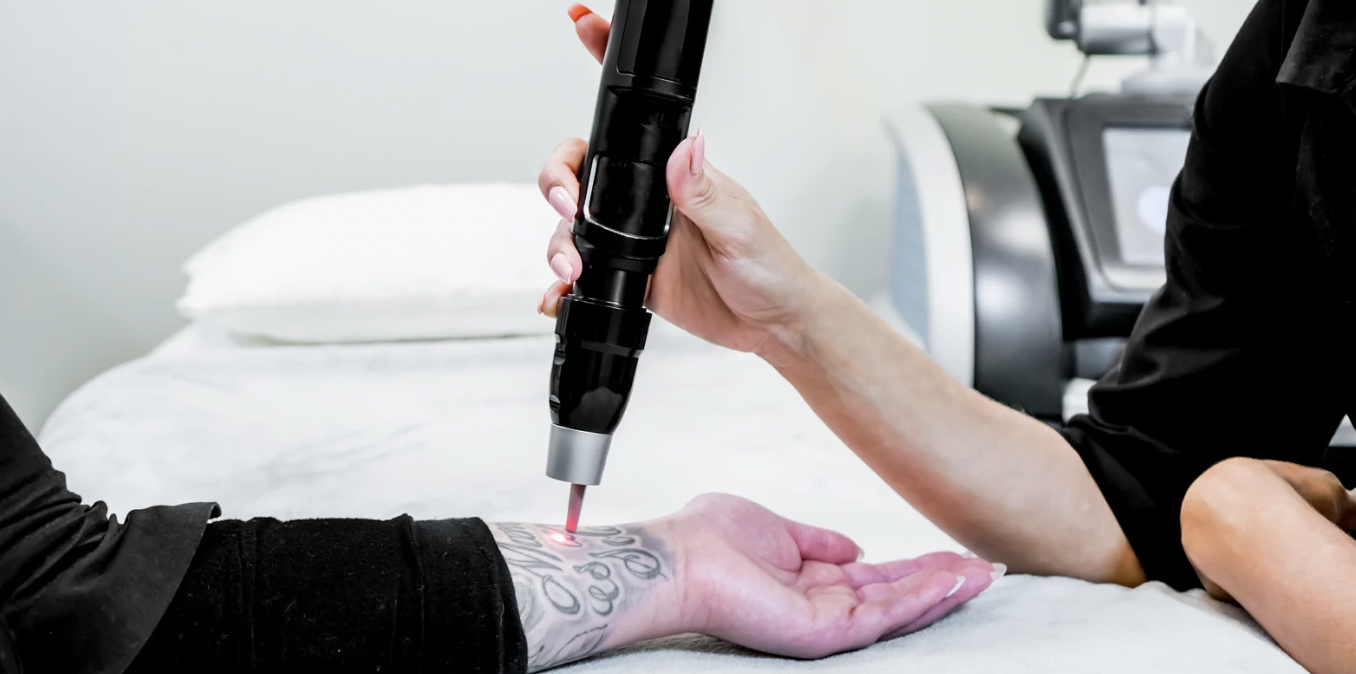 Tattoo Removal Pricing Near Frederick